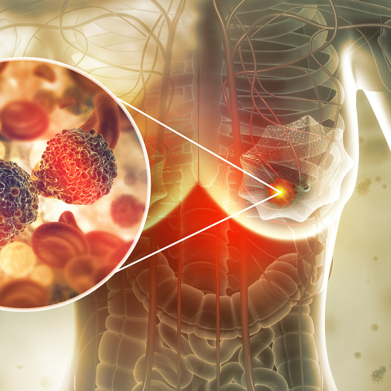 El riesgo de cáncer de mama